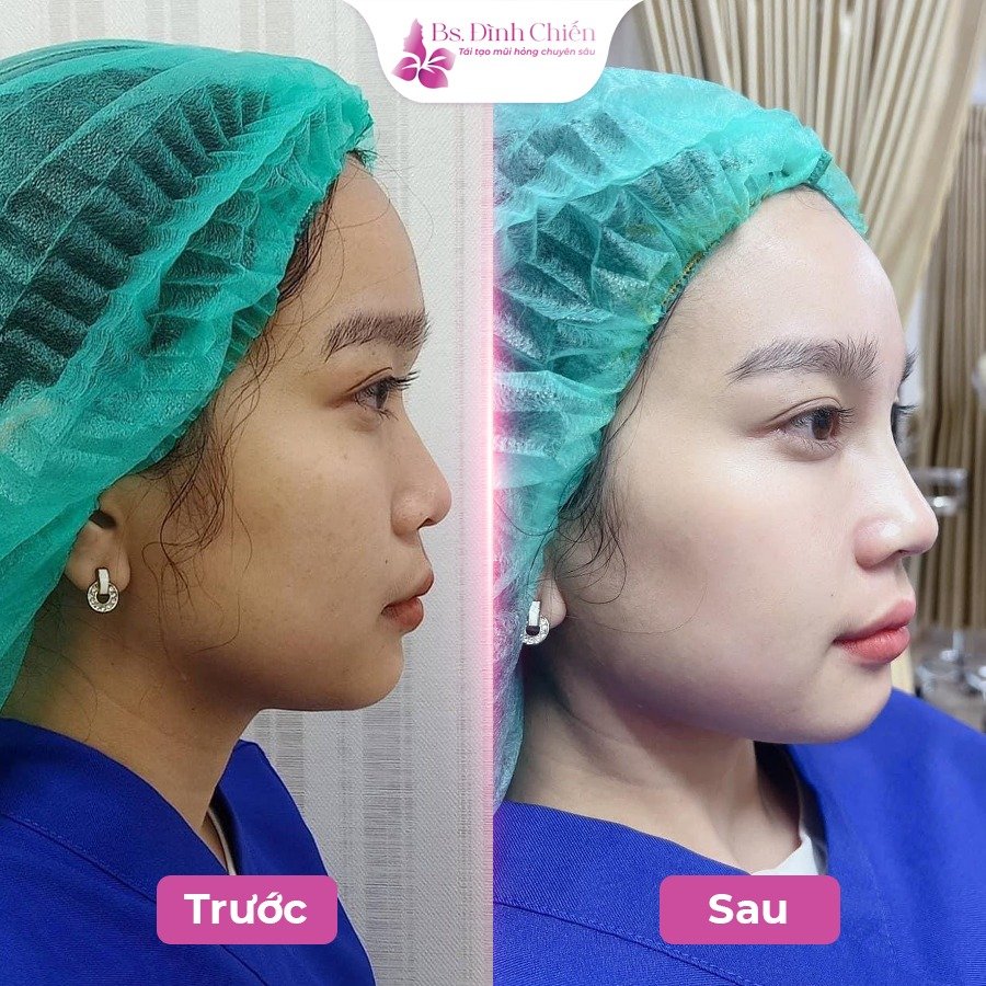 Nâng mũi đẹp giá tốt nhất - trọn gói 16 Nâng mũi cấu trúc