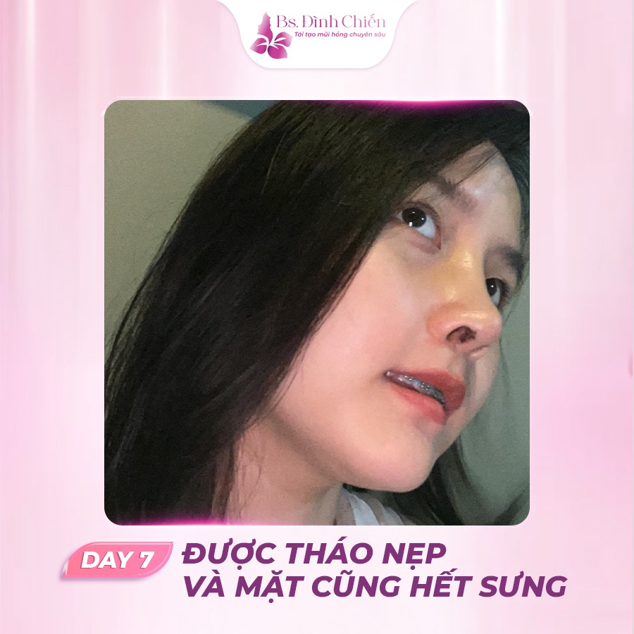 Nâng mũi đẹp giá tốt nhất - trọn gói 15 Hình ảnh khách hàng sau phẫu thuật nâng mũi