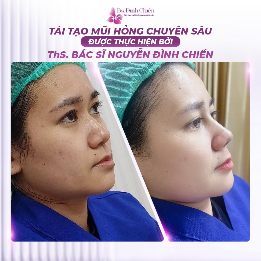 Nâng mũi cấu trúc