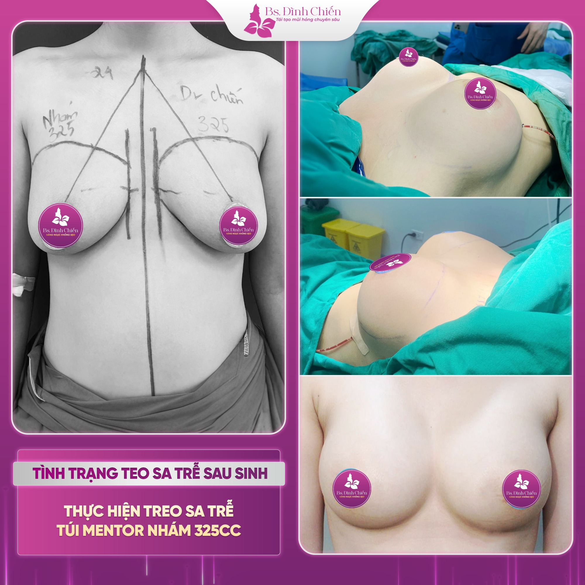 Nâng ngực, phẫu thuật ngực chảy xệ - Chi phí trọn gói 7 Nâng ngực và phẫu thuật ngực chảy xệ