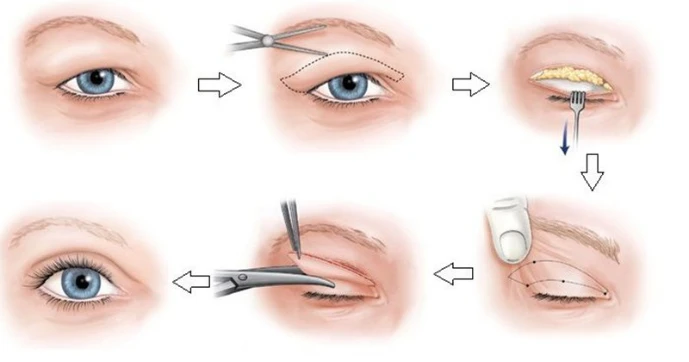 Cắt mí đẹp tự nhiên - Chi phí trọn gói 6 Mô phỏng cắt mí