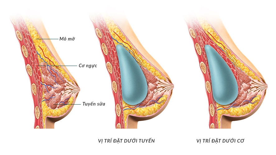 Nâng ngực, phẫu thuật ngực chảy xệ - Chi phí trọn gói 6 vi tri dat tui nguc